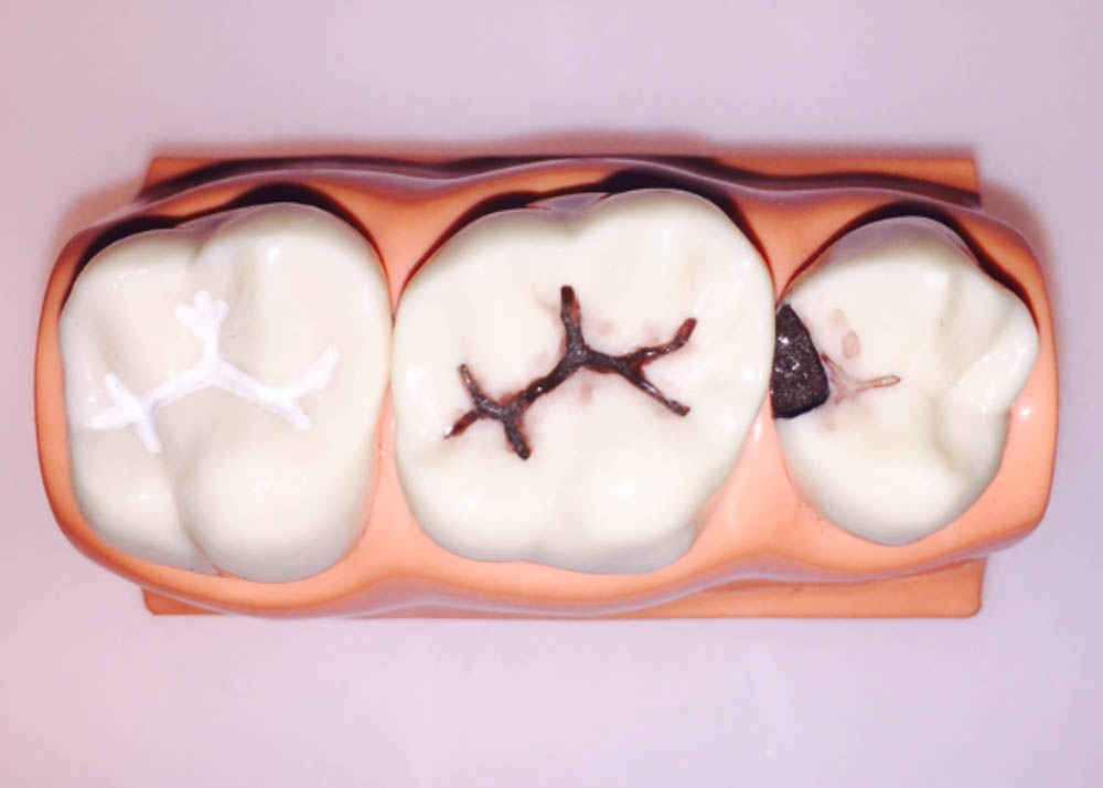 WHAT IS THE ROLE OF SEALANTS IN THE PREVENTION OF TOOTH DECAY? Prisma